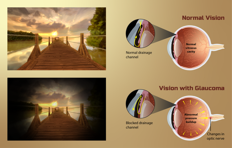 File:Depiction of vision for a Glaucoma patient.png