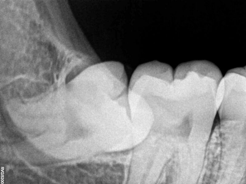 File:Impacted Wisdom Tooth aka Lower Right Third Molar 48 RVG IOPA Xray.jpg