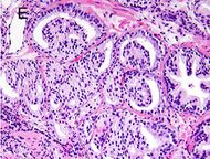 Micrograph of prostate cancer with Gleason score 8 (4+4) with glomeruloid glands.jpg