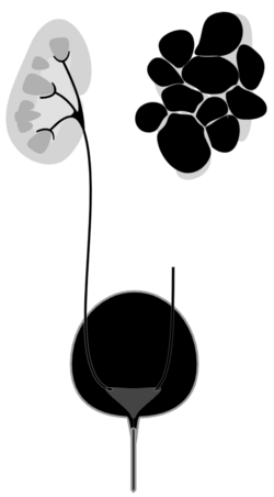 Multicystic Dysplastic kidney (cropped).png
