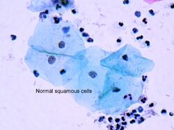 Squamous cells.jpg