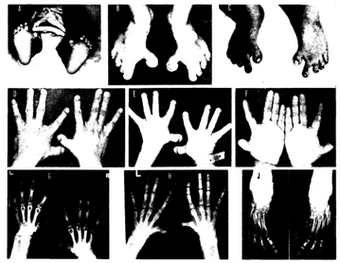 Hands, feet, and radiographs of family with Brachydactyly-preaxial hallux varus syndrome.png