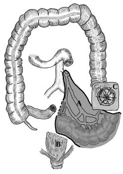 Hartmans Operation of the Colon (Sigma).jpg