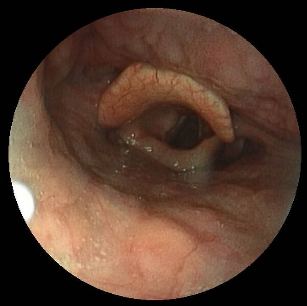 File:Normal Epiglottis.jpg