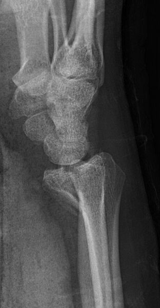 File:Radiograph of Barton's fracture.jpg