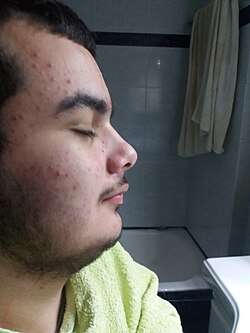 Teenager with acne.jpg