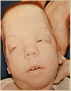 Smith-Lemli-Opitz Syndrome 1.jpg