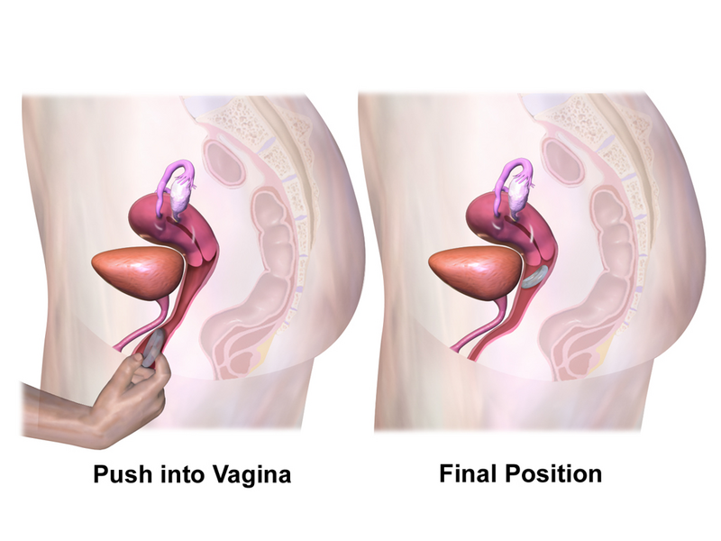 File:Vaginal Ring Application (Steps 2 & 3).png
