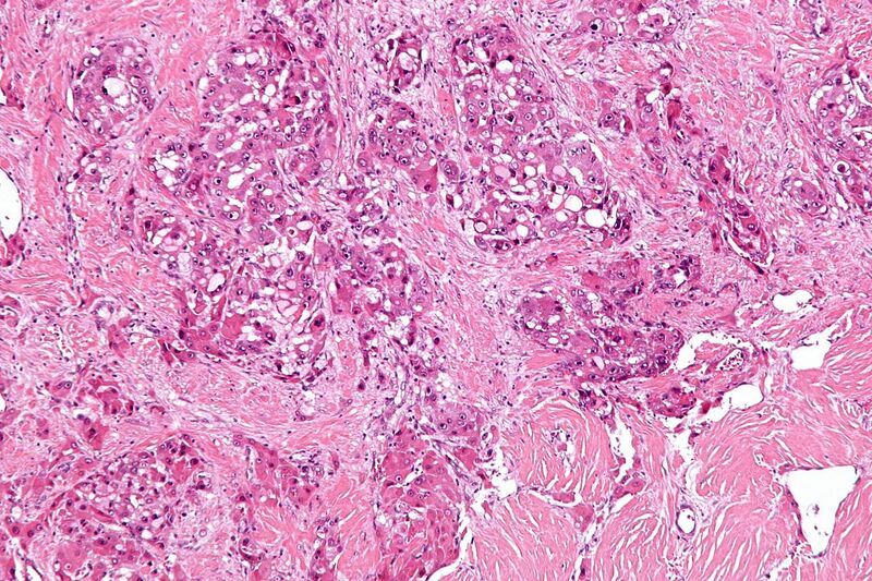 File:Fibrolamellar hepatocellular carcinoma -2- intermed mag.jpg