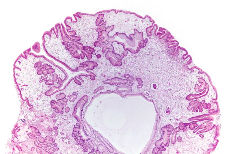 File:Gastric juvenile polyp - very low mag.jpg