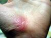 Hand Abrasion - 30 days 4 hours 43 minutes after injury.JPG