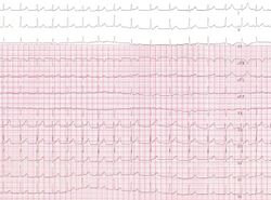 JEt (CardioNetworks ECGpedia).jpg