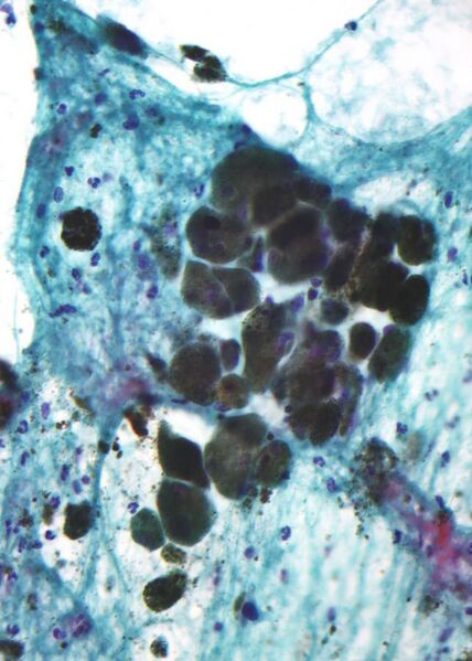 File:Pigmented melanoma - cytology.jpg
