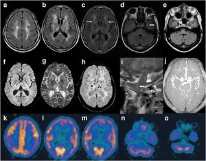 Cranial imaging of a FFI patient.jpg