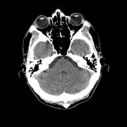 Head CT scan.jpg