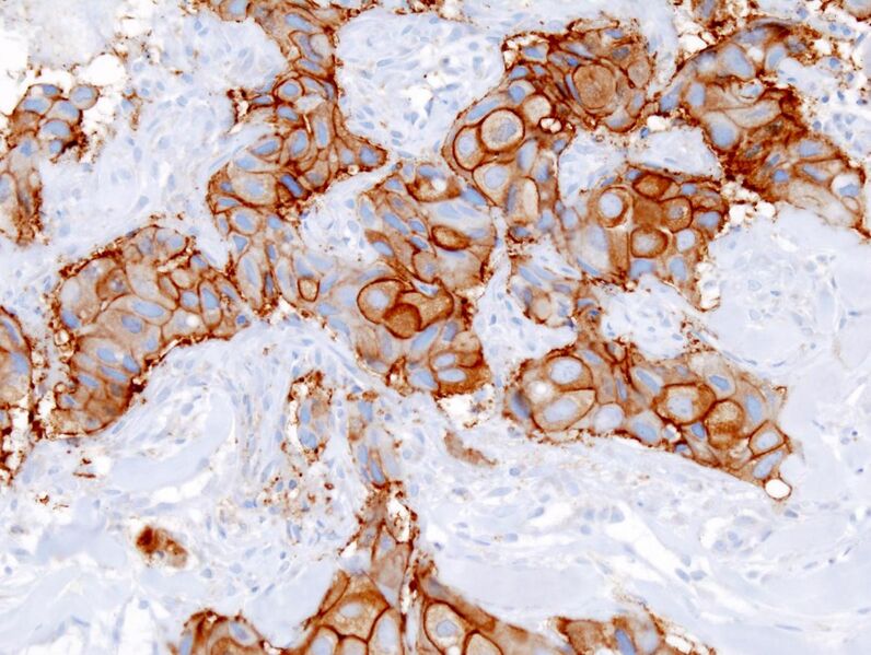 File:Breast invasive scirrhous carcinoma histopathology (2) HER2 expression.JPG