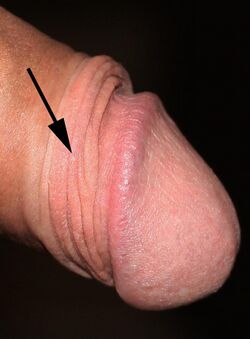Foreskin of intact penis showing ridged band with arrow.jpg