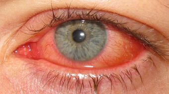 Keratoconjunctivitis epidemica 2.jpg