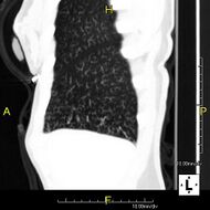 Primary ciliary dyskinesia-12.jpg