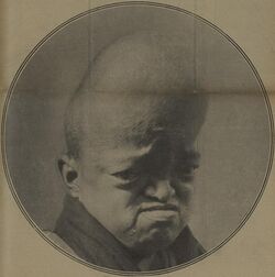 Chinese circus performer with craniosynostosis, 1927.jpg