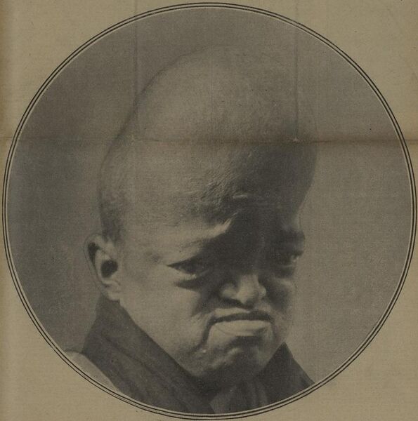 File:Chinese circus performer with craniosynostosis, 1927.jpg