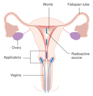 File:Diagram showing the position of the applicators for internal radiotherapy for cervical cancer CRUK 344.svg