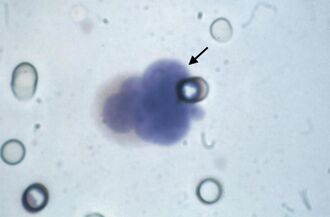 Figure 1, Picture of a circulating tumor cell, arrow, diagnosed by the ISET test..jpg