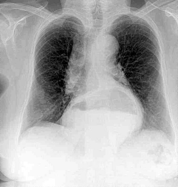 File:Radiografía pulmones Francisca Lorca.cropped.jpg