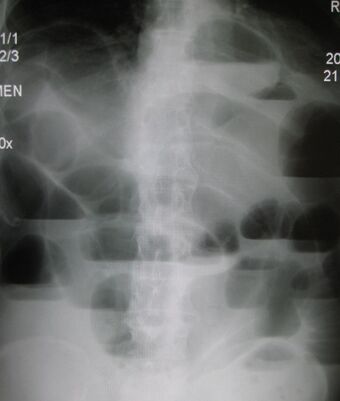 Upright X-ray demonstrating small bowel obstruction.jpg