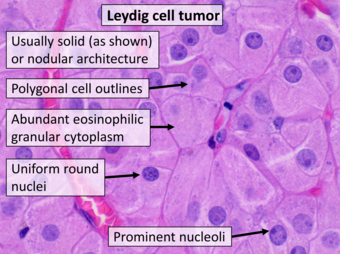 Histopathology of leydig cell tumor of the ovary, high mag, annotated.png