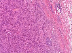 This image was originally posted to Flickr by Pulmonary Pathology at https://flickr.com/photos/30950973@N03/5601450952 (archive). It was reviewed on 3 October 2019 by FlickreviewR 2 and was confirmed to be licensed under the terms of the cc-by-sa-2.0.