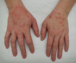 Dermatitis2015.jpg