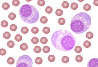 Plasma cell leukemia.jpg