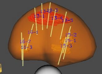 Targeted MRI-US fusion prostate biopsy at UCLA.jpg