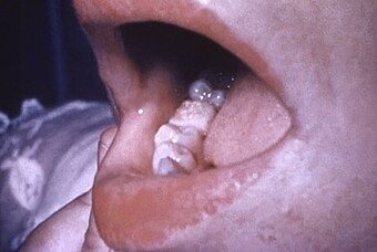 Congenital syphilis. Mulberry molar.jpg