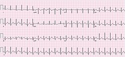 ECG Sinus Tachycardia 132 bpm.jpg