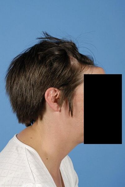 File:Forehead bulk defect picture 1.jpg