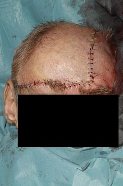 Forehead scalp defect picture 3.jpg