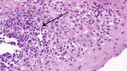 Lymphocytic esophagitis histology.jpg