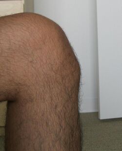 25-year-old male with Osgood–Schlatter disease.