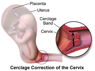 Cervical Cerclage.png