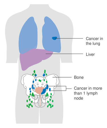 File:Diagram showing advanced bladder cancer CRUK 441.svg