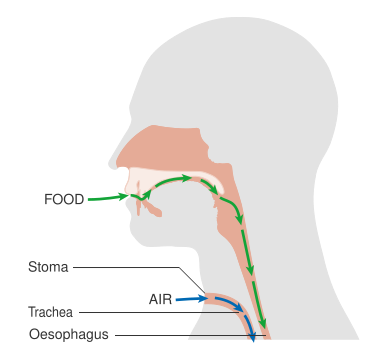File:Diagram showing the position of the stoma after a laryngectomy CRUK 361.svg