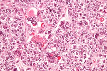 Juvenile granulosa cell tumour - very high mag.jpg