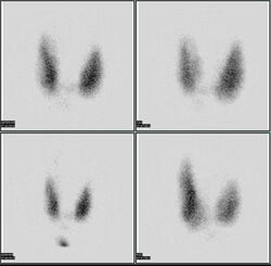 Thyroid scan.jpg