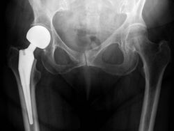 X-ray of hips with a hemiarthroplasty.jpg