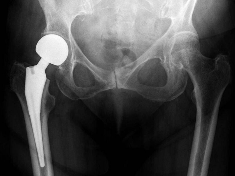 File:X-ray of hips with a hemiarthroplasty.jpg
