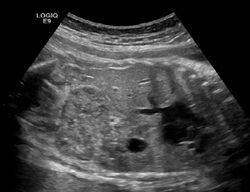 Ectopic crossed fused kidney.jpg