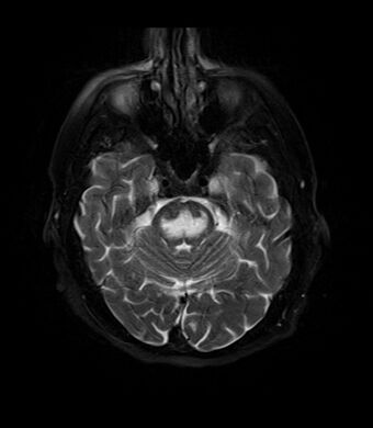 MRI Central Pontine Myelinolysis fat sat T2.jpg