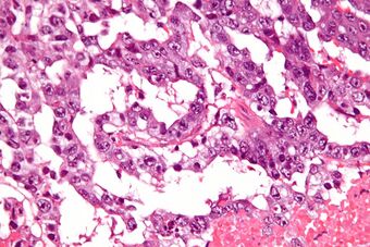 Mixed germ cell tumour - very high mag.jpg